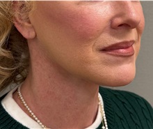 Neck Lift After Photo by Keshav Magge, MD; Bethesda, MD - Case 50810