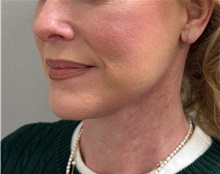 Neck Lift After Photo by Keshav Magge, MD; Bethesda, MD - Case 50810