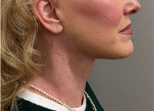 Neck Lift After Photo by Keshav Magge, MD; Bethesda, MD - Case 50810