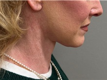 Neck Lift After Photo by Keshav Magge, MD; Bethesda, MD - Case 50810