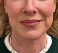 Neck Lift After Photo by Keshav Magge, MD; Bethesda, MD - Case 50810