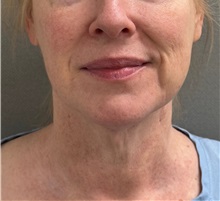 Neck Lift Before Photo by Keshav Magge, MD; Bethesda, MD - Case 50810