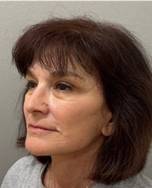 Neck Lift After Photo by Keshav Magge, MD; Bethesda, MD - Case 50838
