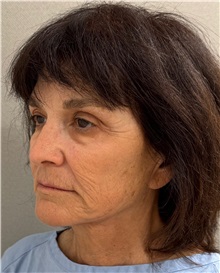 Neck Lift Before Photo by Keshav Magge, MD; Bethesda, MD - Case 50838