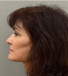 Neck Lift After Photo by Keshav Magge, MD; Bethesda, MD - Case 50838