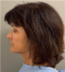 Neck Lift Before Photo by Keshav Magge, MD; Bethesda, MD - Case 50838