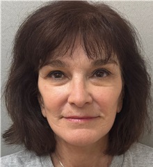 Neck Lift After Photo by Keshav Magge, MD; Bethesda, MD - Case 50838