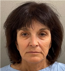 Neck Lift Before Photo by Keshav Magge, MD; Bethesda, MD - Case 50838