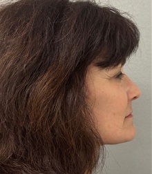 Neck Lift After Photo by Keshav Magge, MD; Bethesda, MD - Case 50838