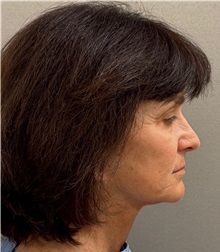 Neck Lift Before Photo by Keshav Magge, MD; Bethesda, MD - Case 50838