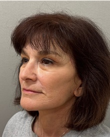 Facelift After Photo by Keshav Magge, MD; Bethesda, MD - Case 50839