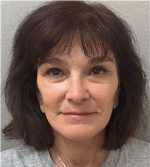 Facelift After Photo by Keshav Magge, MD; Bethesda, MD - Case 50839