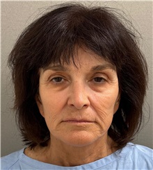 Facelift Before Photo by Keshav Magge, MD; Bethesda, MD - Case 50839