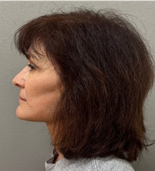Facelift After Photo by Keshav Magge, MD; Bethesda, MD - Case 50839