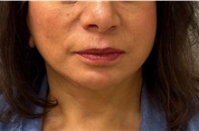 Neck Lift After Photo by Keshav Magge, MD; Bethesda, MD - Case 50850