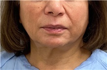 Neck Lift Before Photo by Keshav Magge, MD; Bethesda, MD - Case 50850
