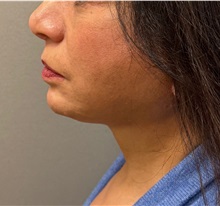 Neck Lift After Photo by Keshav Magge, MD; Bethesda, MD - Case 50850