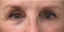 Eyelid Surgery After Photo by Keshav Magge, MD; Bethesda, MD - Case 50853