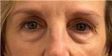 Eyelid Surgery Before Photo by Keshav Magge, MD; Bethesda, MD - Case 50853