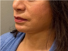 Facelift After Photo by Keshav Magge, MD; Bethesda, MD - Case 50851