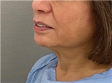 Facelift Before Photo by Keshav Magge, MD; Bethesda, MD - Case 50851