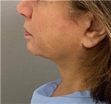Facelift Before Photo by Keshav Magge, MD; Bethesda, MD - Case 50851