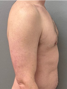 Male Breast Reduction After Photo by Keshav Magge, MD; Bethesda, MD - Case 50852