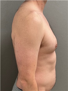 Male Breast Reduction Before Photo by Keshav Magge, MD; Bethesda, MD - Case 50852