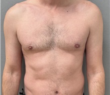 Male Breast Reduction After Photo by Keshav Magge, MD; Bethesda, MD - Case 50852