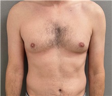 Male Breast Reduction Before Photo by Keshav Magge, MD; Bethesda, MD - Case 50852