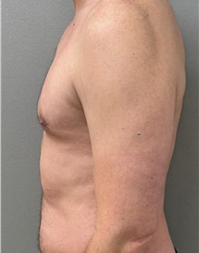 Male Breast Reduction After Photo by Keshav Magge, MD; Bethesda, MD - Case 50852