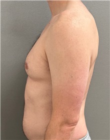 Male Breast Reduction Before Photo by Keshav Magge, MD; Bethesda, MD - Case 50852