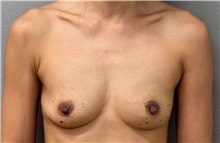 Breast Augmentation Before Photo by Keshav Magge, MD; Bethesda, MD - Case 50859