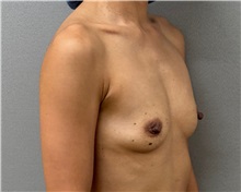 Breast Augmentation Before Photo by Keshav Magge, MD; Bethesda, MD - Case 50859