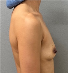 Breast Augmentation Before Photo by Keshav Magge, MD; Bethesda, MD - Case 50859