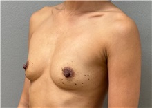 Breast Augmentation Before Photo by Keshav Magge, MD; Bethesda, MD - Case 50859