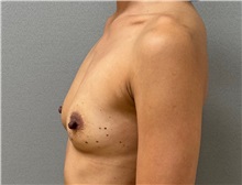 Breast Augmentation Before Photo by Keshav Magge, MD; Bethesda, MD - Case 50859