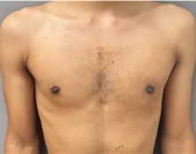 Male Breast Reduction After Photo by Keshav Magge, MD; Bethesda, MD - Case 50860