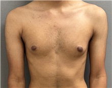 Male Breast Reduction Before Photo by Keshav Magge, MD; Bethesda, MD - Case 50860