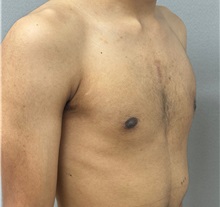 Male Breast Reduction After Photo by Keshav Magge, MD; Bethesda, MD - Case 50860