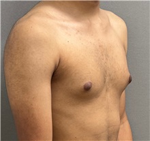 Male Breast Reduction Before Photo by Keshav Magge, MD; Bethesda, MD - Case 50860