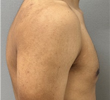 Male Breast Reduction After Photo by Keshav Magge, MD; Bethesda, MD - Case 50860