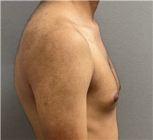 Male Breast Reduction Before Photo by Keshav Magge, MD; Bethesda, MD - Case 50860