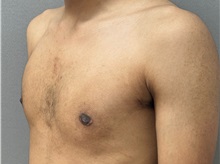 Male Breast Reduction After Photo by Keshav Magge, MD; Bethesda, MD - Case 50860