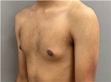 Male Breast Reduction Before Photo by Keshav Magge, MD; Bethesda, MD - Case 50860