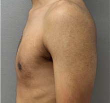 Male Breast Reduction After Photo by Keshav Magge, MD; Bethesda, MD - Case 50860