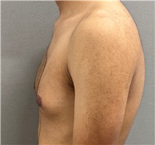 Male Breast Reduction Before Photo by Keshav Magge, MD; Bethesda, MD - Case 50860