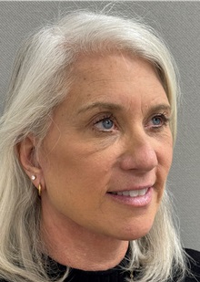 Neck Lift After Photo by Keshav Magge, MD; Bethesda, MD - Case 50861