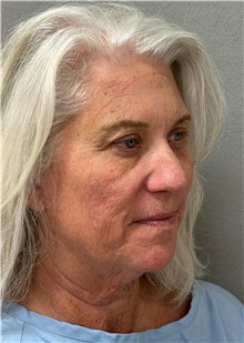Neck Lift Before Photo by Keshav Magge, MD; Bethesda, MD - Case 50861