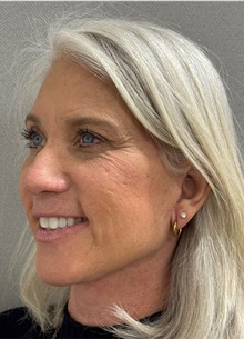 Neck Lift After Photo by Keshav Magge, MD; Bethesda, MD - Case 50861
